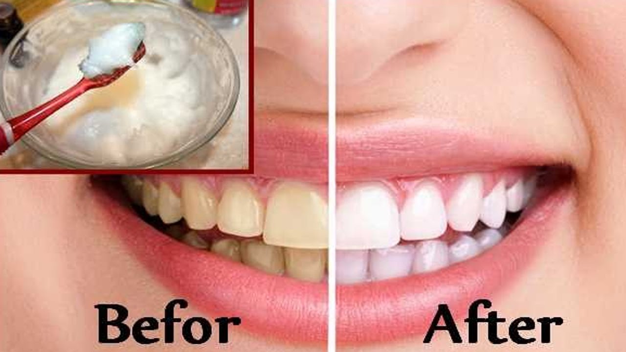 teeth whitening baking powder or bicarbonate of soda