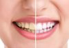Natural ways to avoid yellow teeth