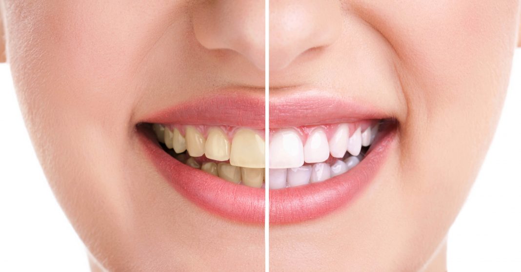 Natural ways to avoid yellow teeth